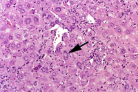 oval cell hyperplasia